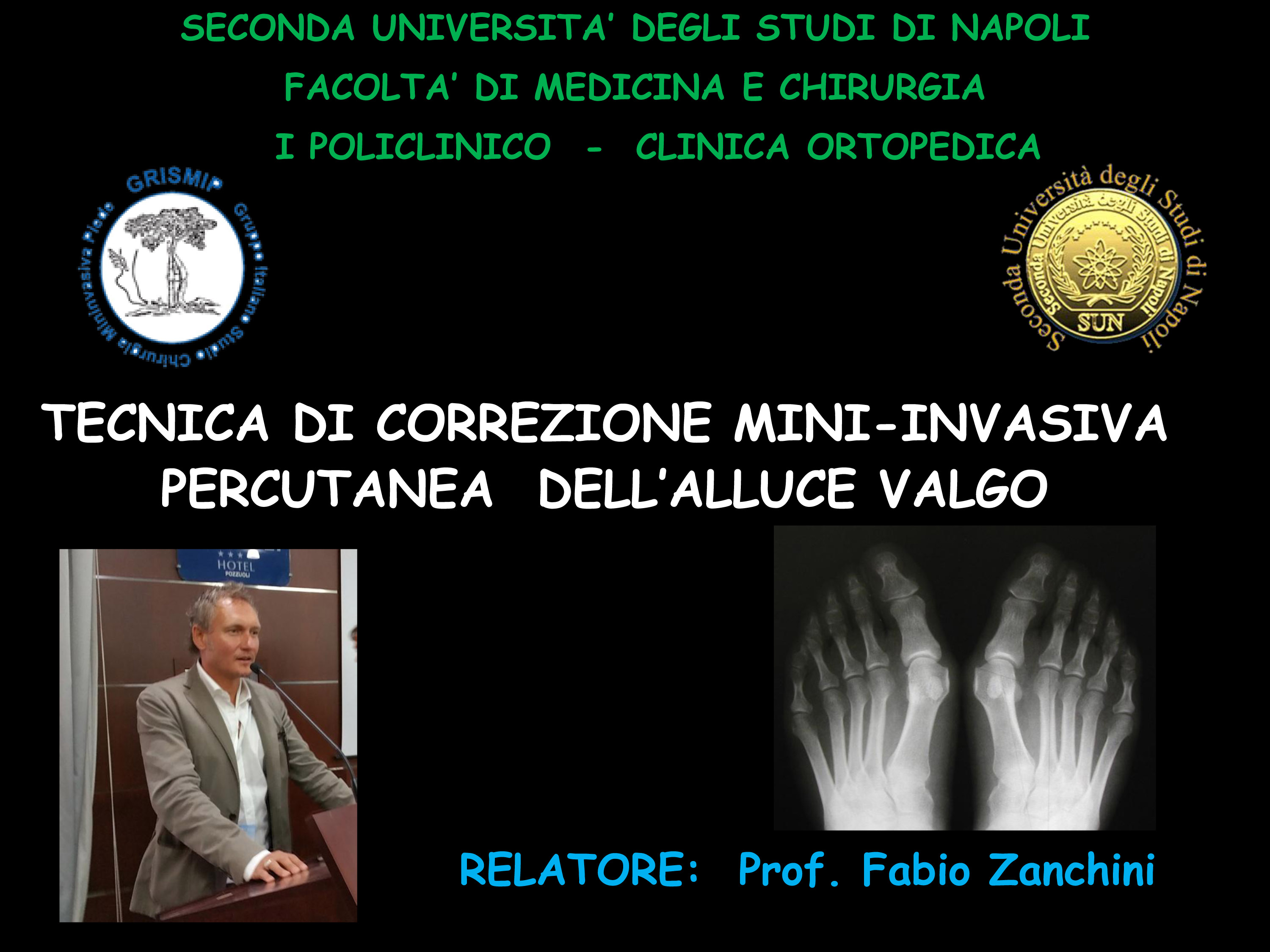 Alluce valgo tecnica mininvasiva