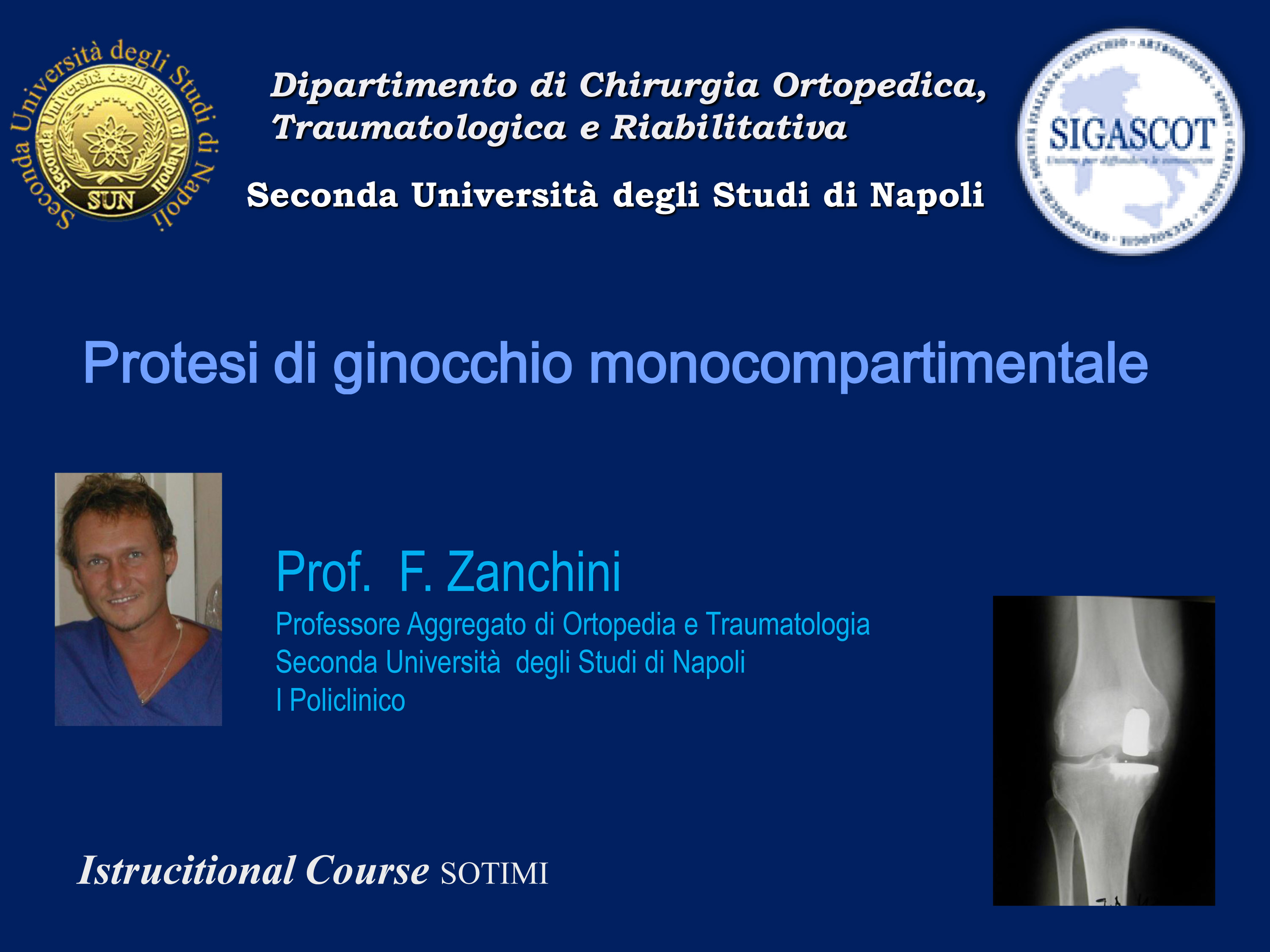PROTESI MONOCOMPARTIMENTALE