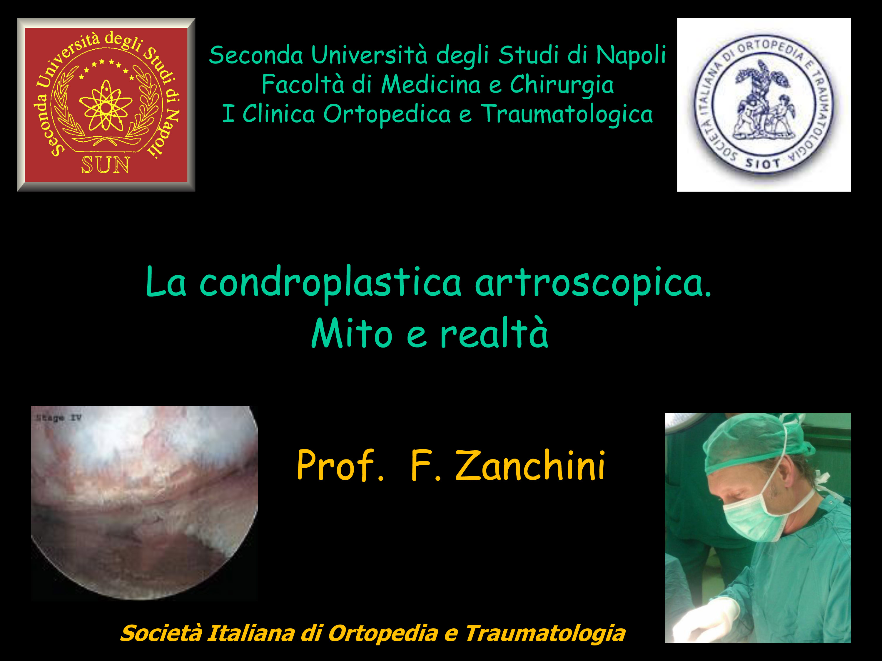 la condroplastica artroscopica